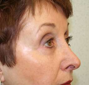 Blepharoplasty