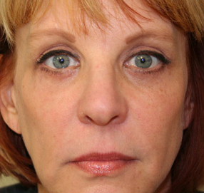 Blepharoplasty