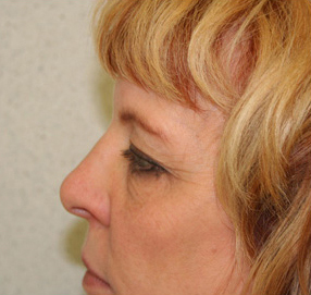 Blepharoplasty