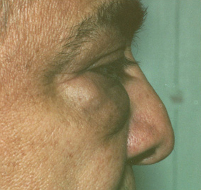 Blepharoplasty