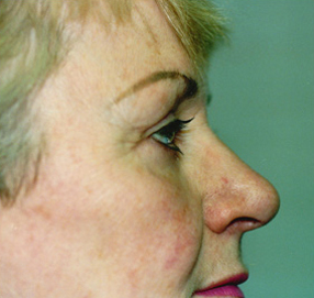 Blepharoplasty