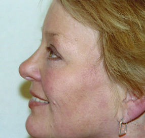 Blepharoplasty