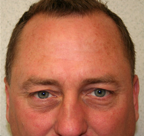 Blepharoplasty