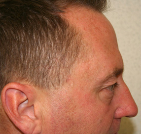 Blepharoplasty