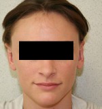 Otoplasty
