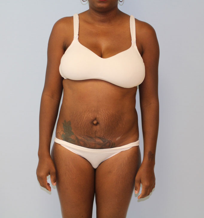 Tummy Tuck