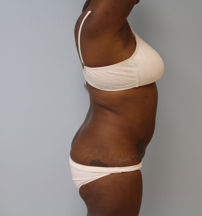 Tummy Tuck