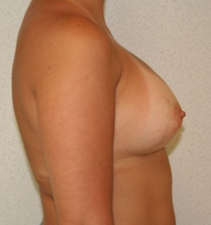 Breast Augmentation