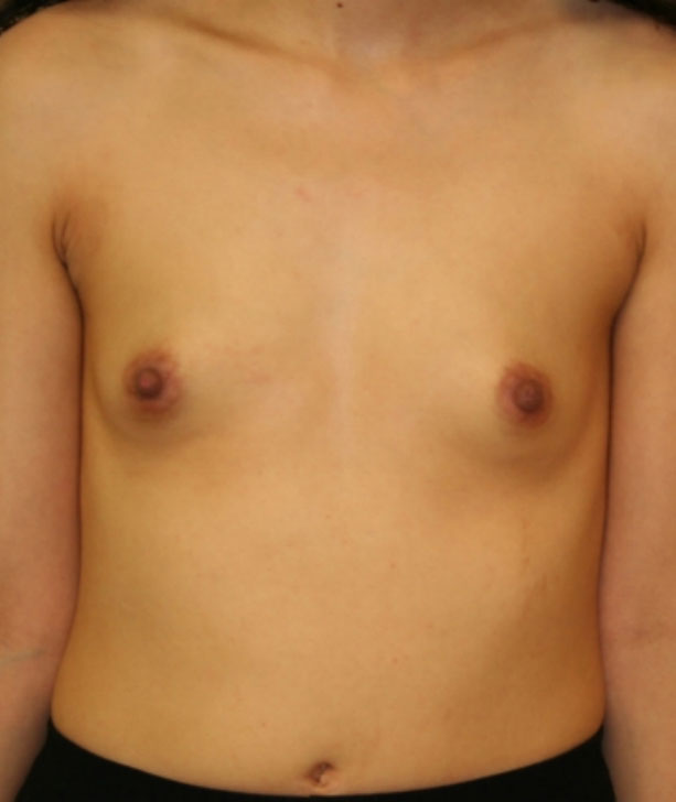 Breast Augmentation