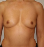 Breast Augmentation