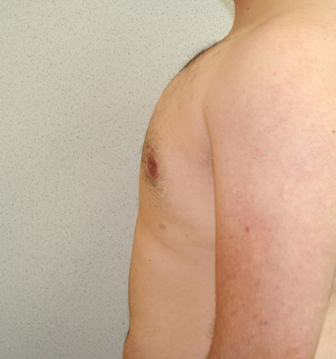 Gynecomastia