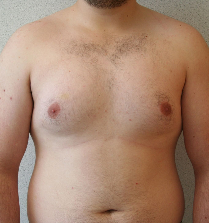 Gynecomastia