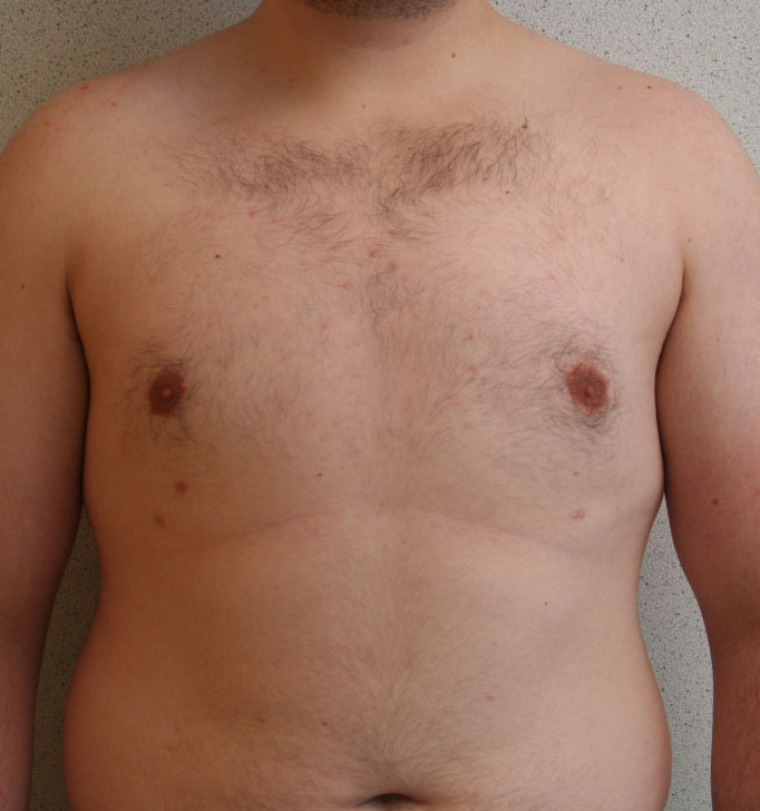 Gynecomastia