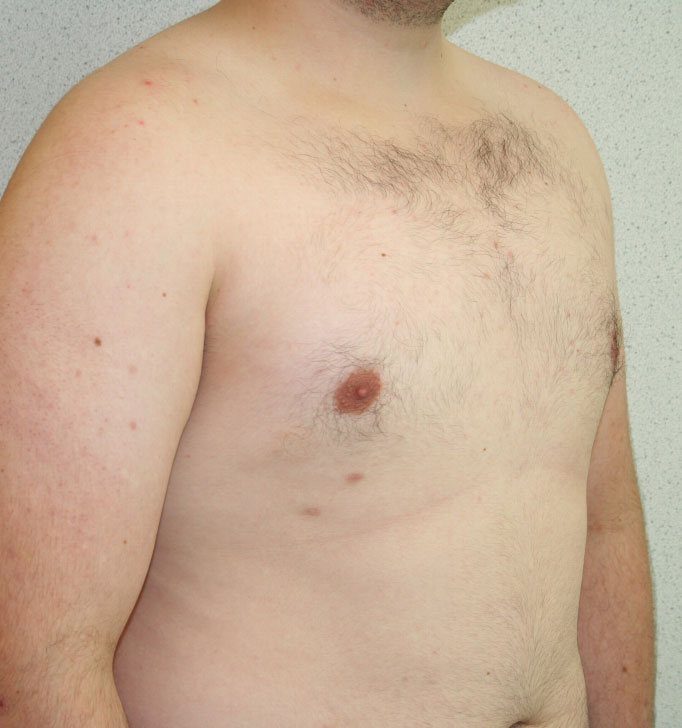 Gynecomastia