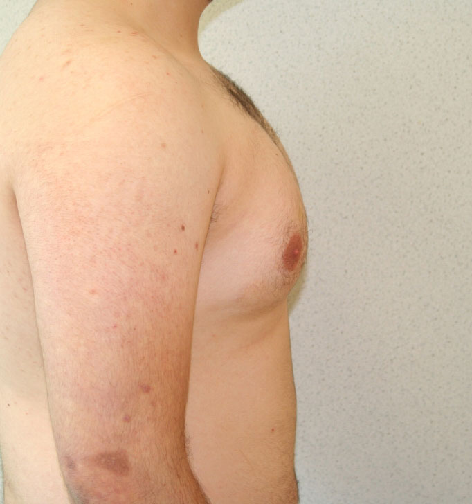 Gynecomastia