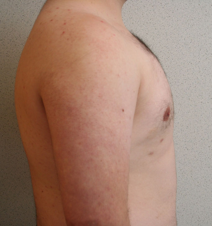 Gynecomastia