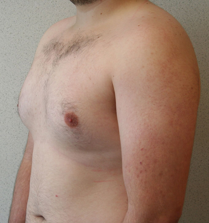 Gynecomastia