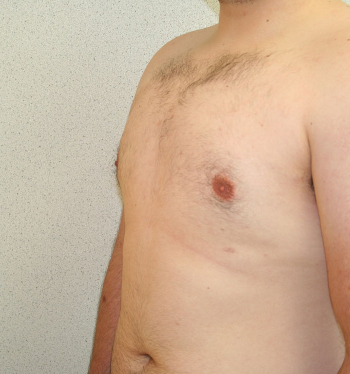 Gynecomastia