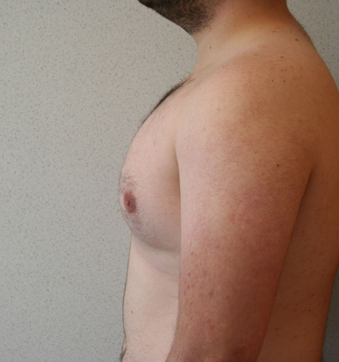 Gynecomastia
