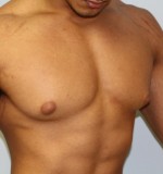 Gynecomastia