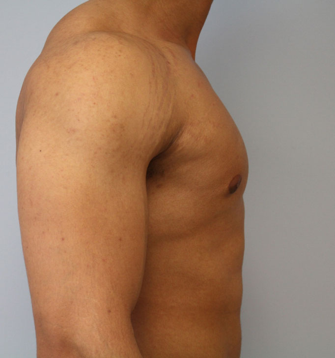 Gynecomastia