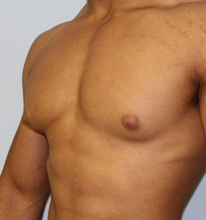 Gynecomastia