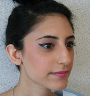 Otoplasty