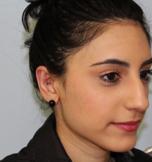 Otoplasty