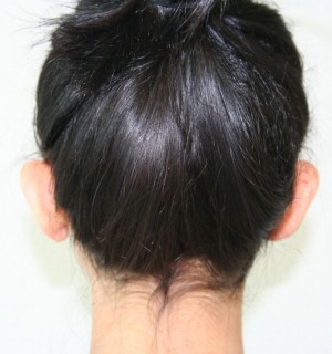 Otoplasty