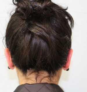 Otoplasty