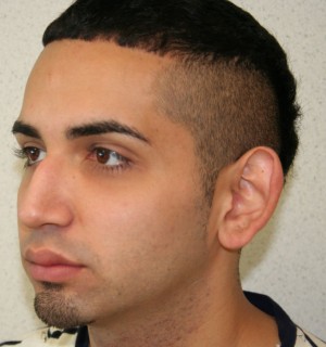 Otoplasty