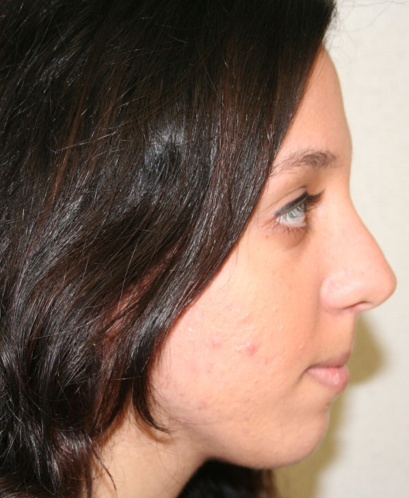 Rhinoplasty