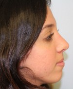 Rhinoplasty