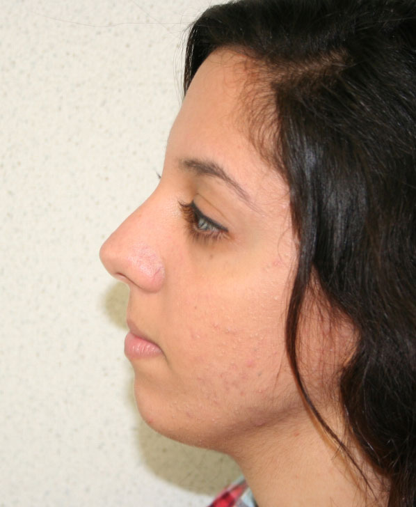 Rhinoplasty