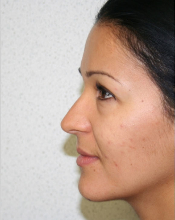 Rhinoplasty