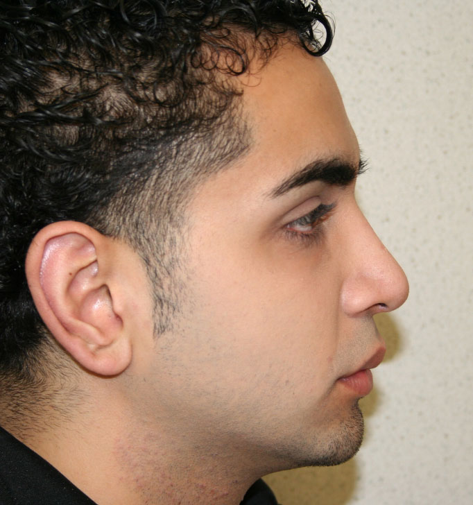 Rhinoplasty