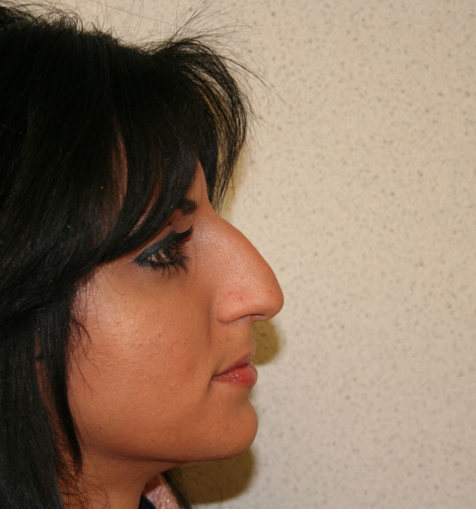 Rhinoplasty