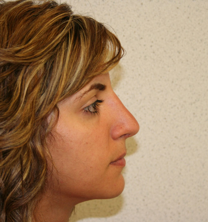 Rhinoplasty