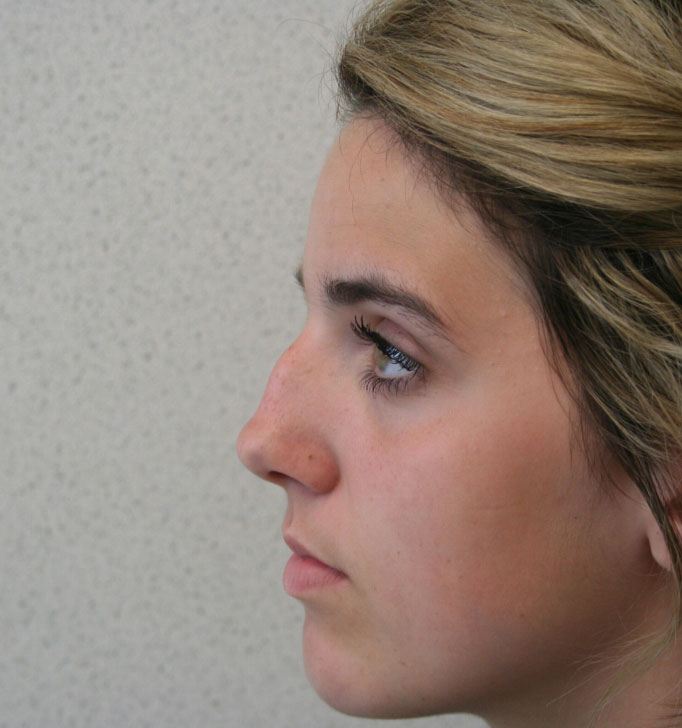 Rhinoplasty