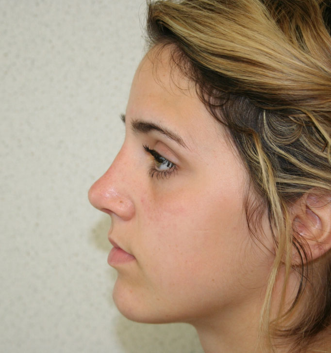 Rhinoplasty