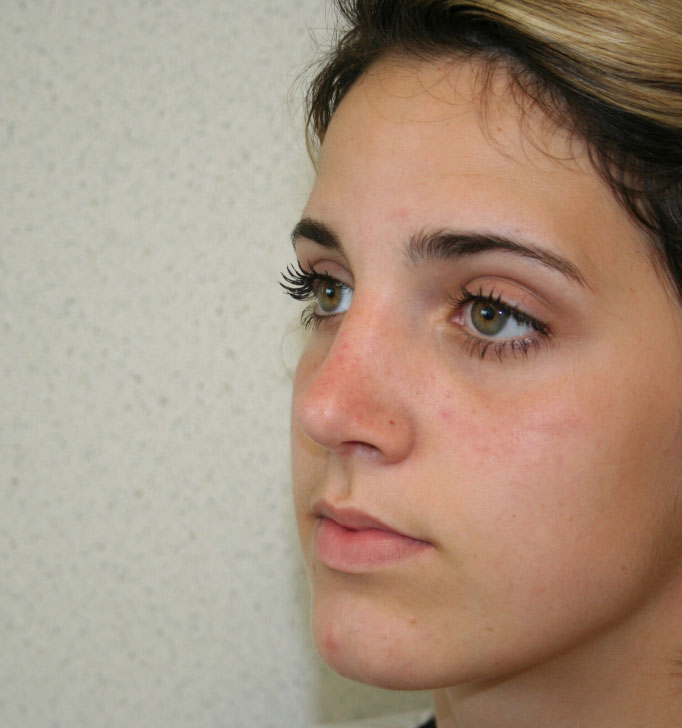 Rhinoplasty