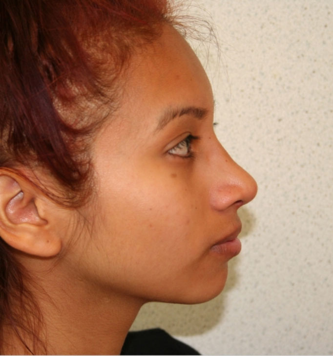 Rhinoplasty