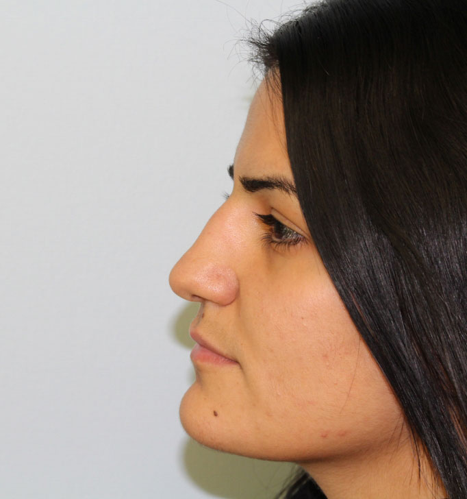 Rhinoplasty