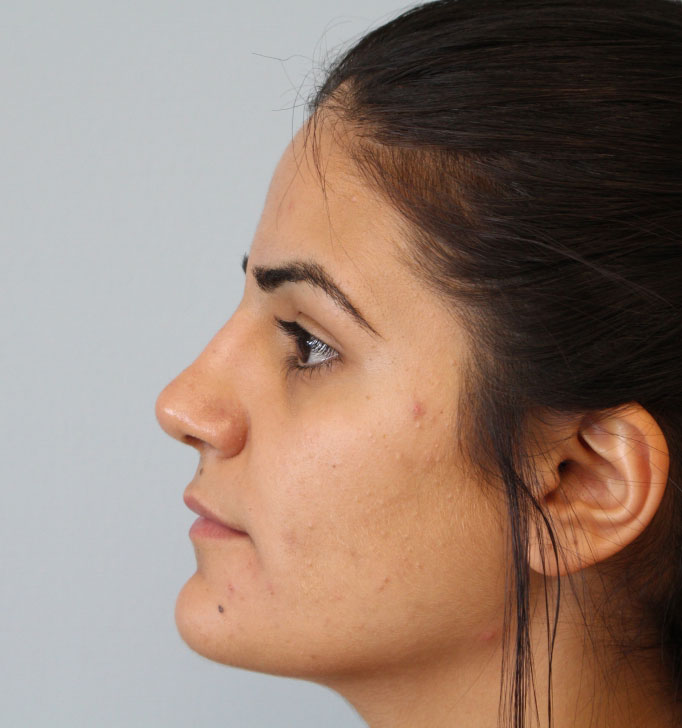 Rhinoplasty