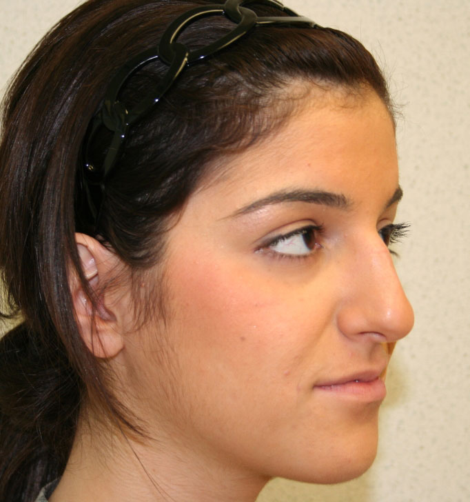 Rhinoplasty