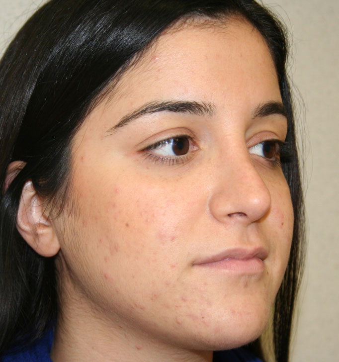 Rhinoplasty