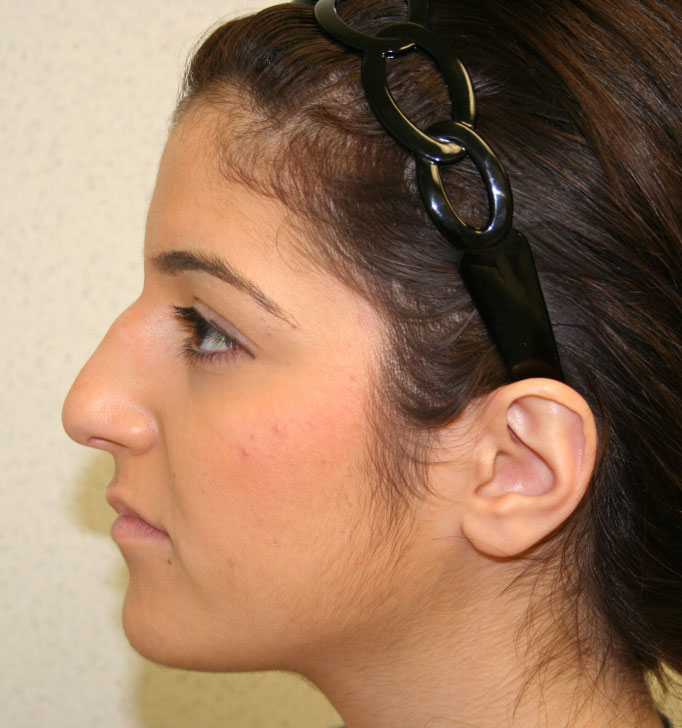 Rhinoplasty