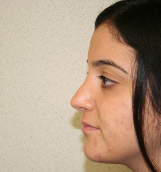 Rhinoplasty