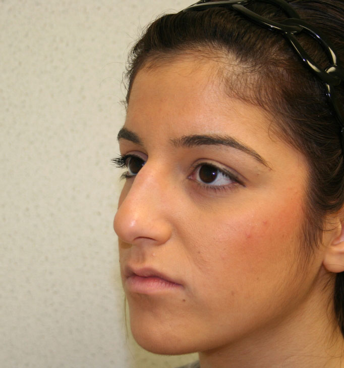 Rhinoplasty