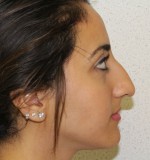 Rhinoplasty